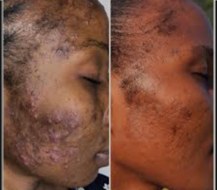 Blackhead,Spots Combo