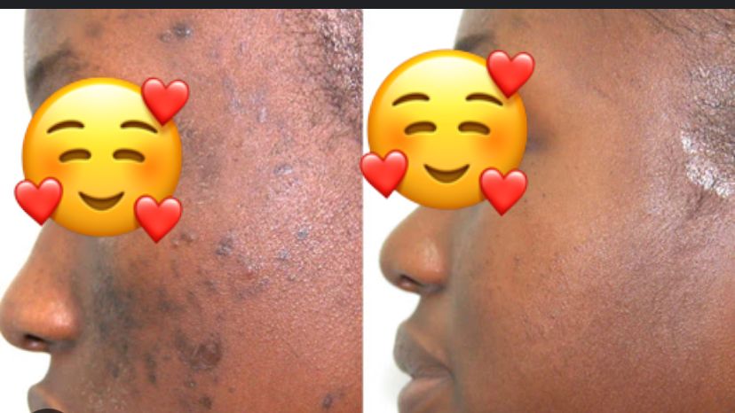 Blackspots & Dark Spots Brightening combo